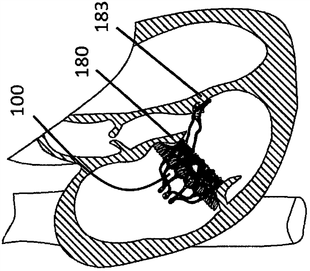 An adaptive heart valve prosthesis