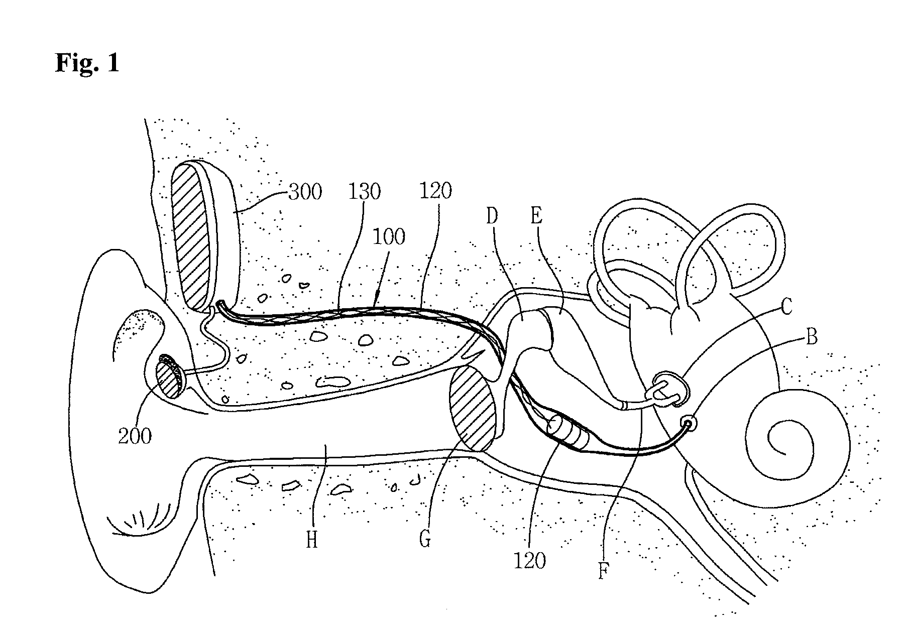 Implantable middle ear hearing device having tubular vibration transducer to drive round window