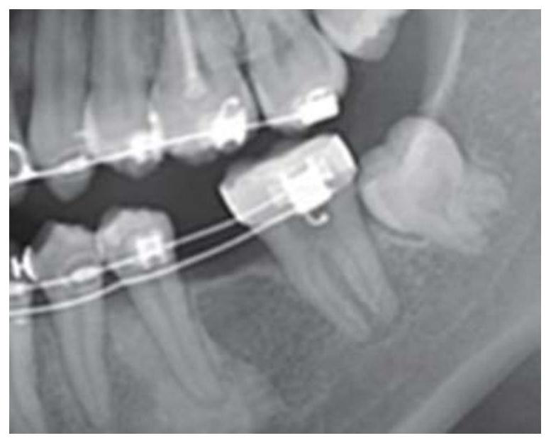 A device and orthodontic method for moving molars by distraction osteogenesis of periodontal ligament