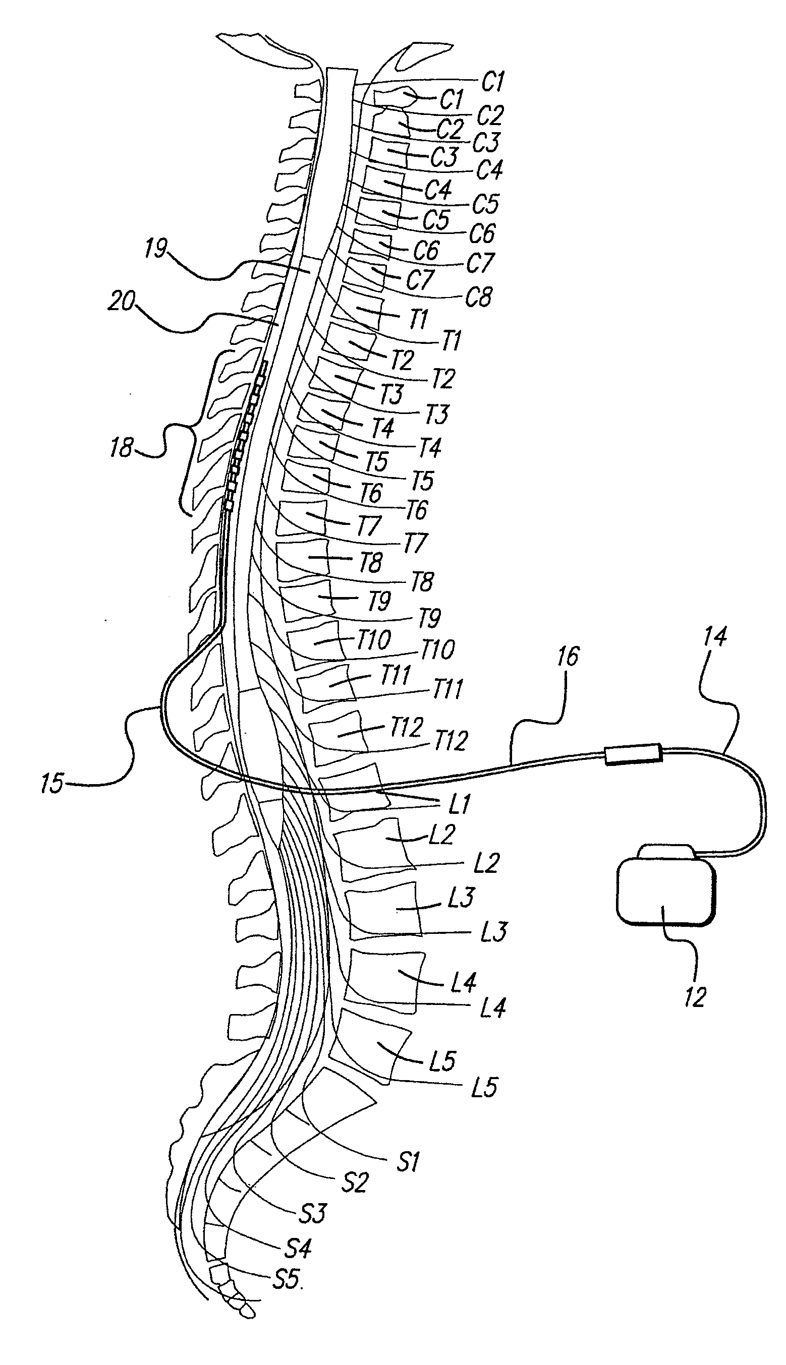 Neural stimulation system providing auto adjustment of stimulus output as a function of sensed impedance