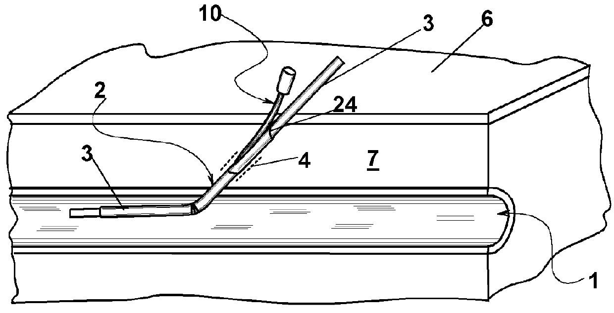 Occlusion device for vascular surgery