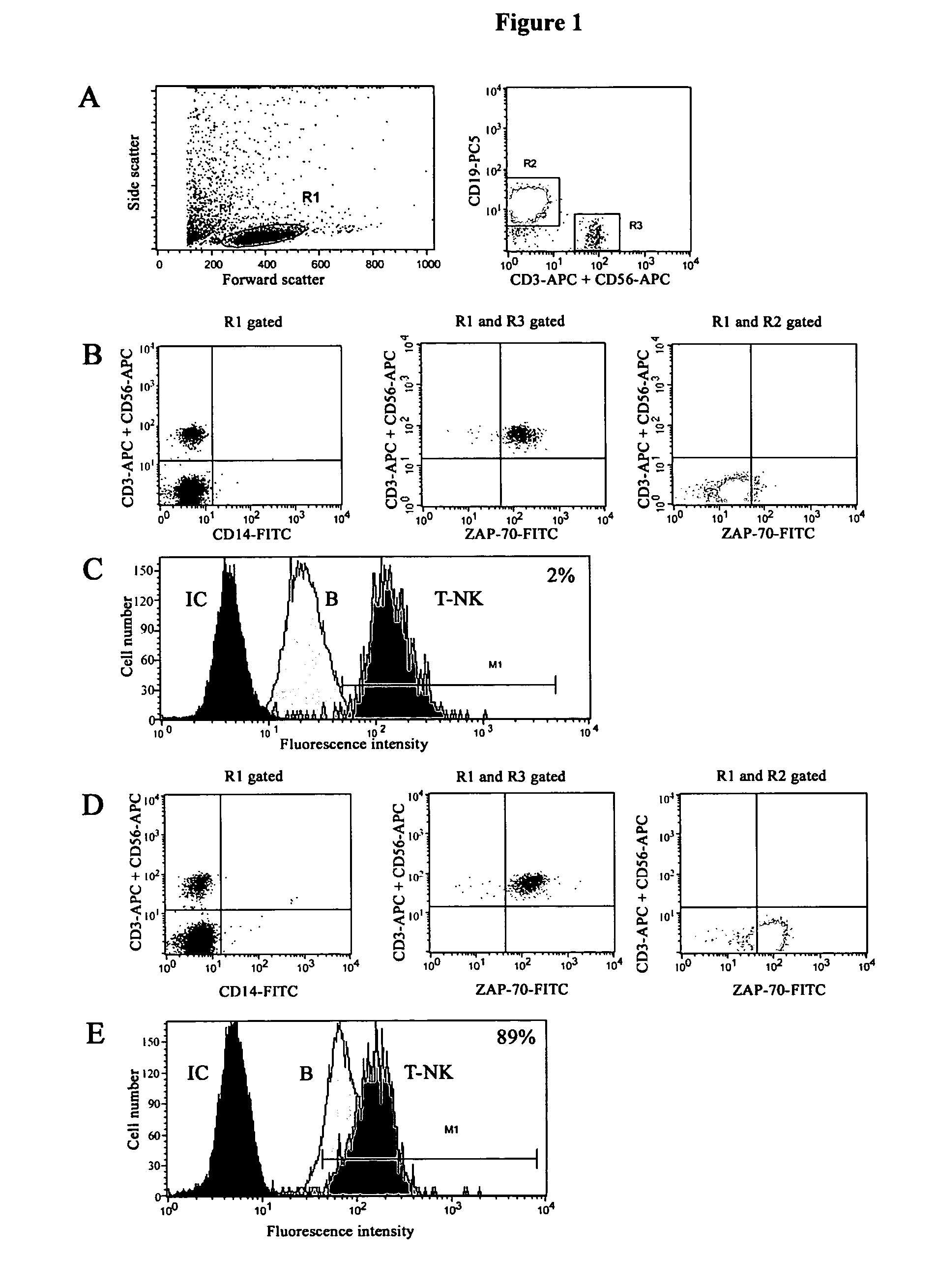 Method of diagnosis/prognosis of human chronic lymphocytic leukemia comprising the profiling of LPL/ADAM genes