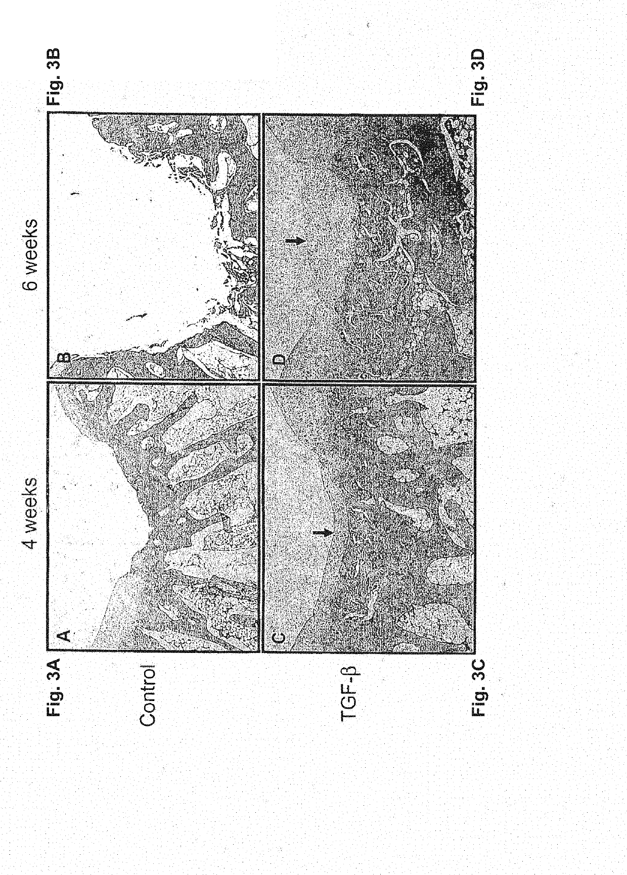 Cartilage regeneration using chondrocyte and tgf-beta