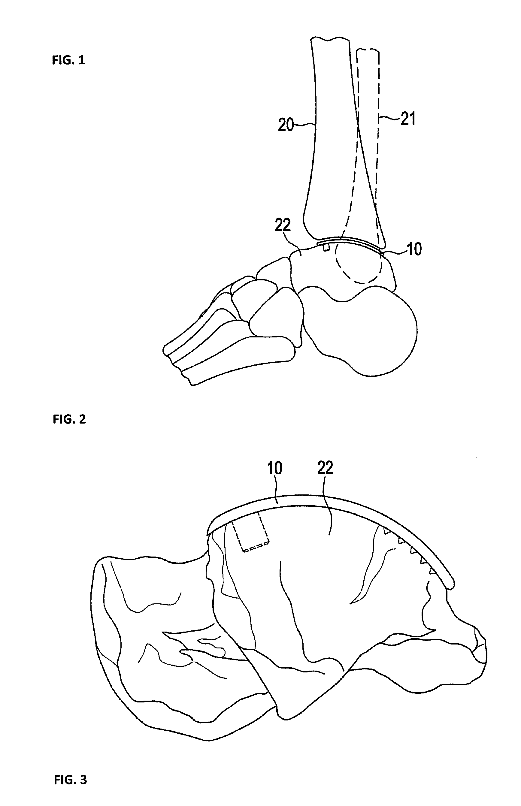 Talus surface implant