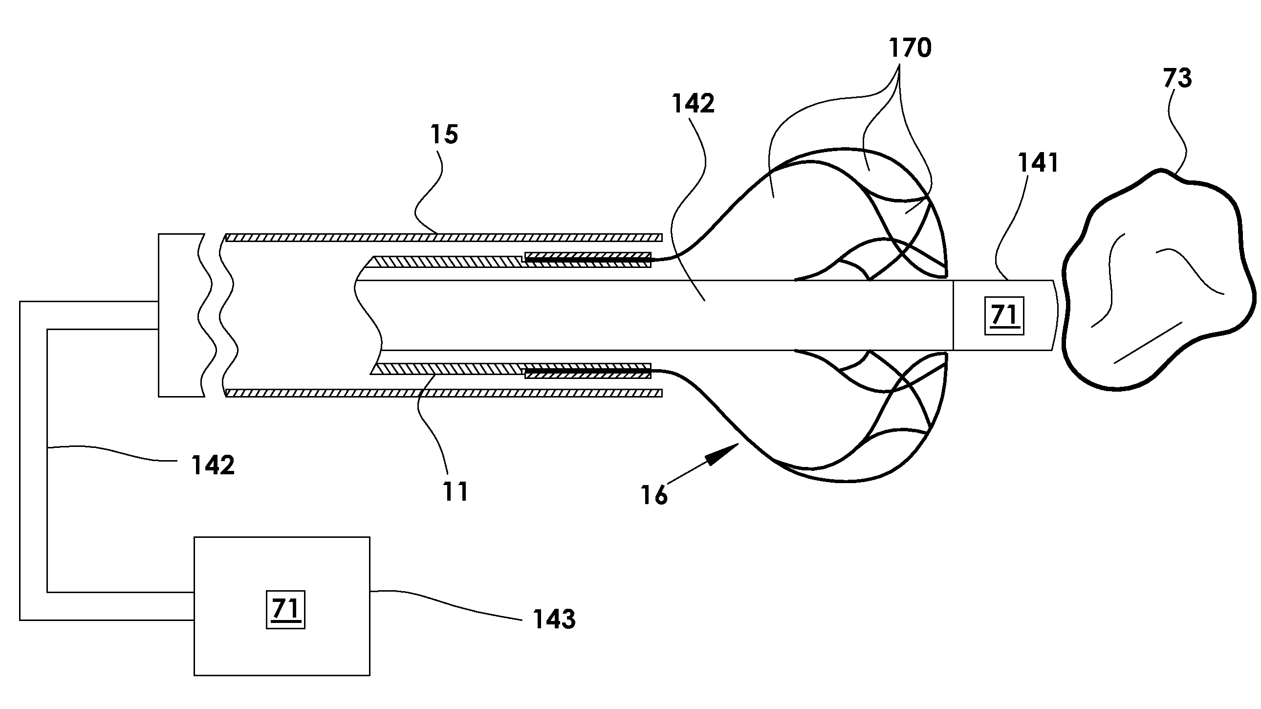 Device and method for fragmenting and removing concretions from body ducts and cavities