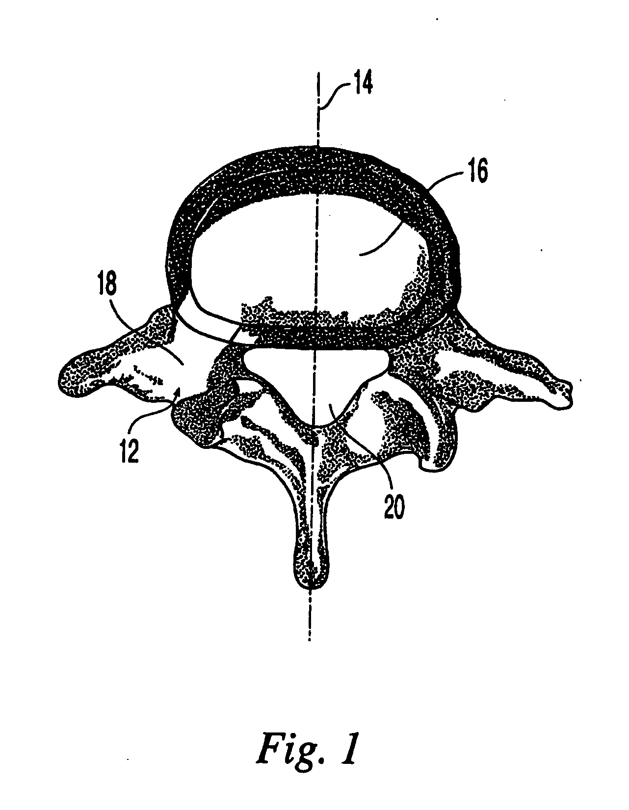 Intervertebral implant for transforaminal posterior lumbar interbody fusion procedure