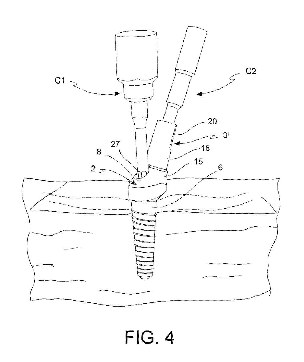 Dental implant device