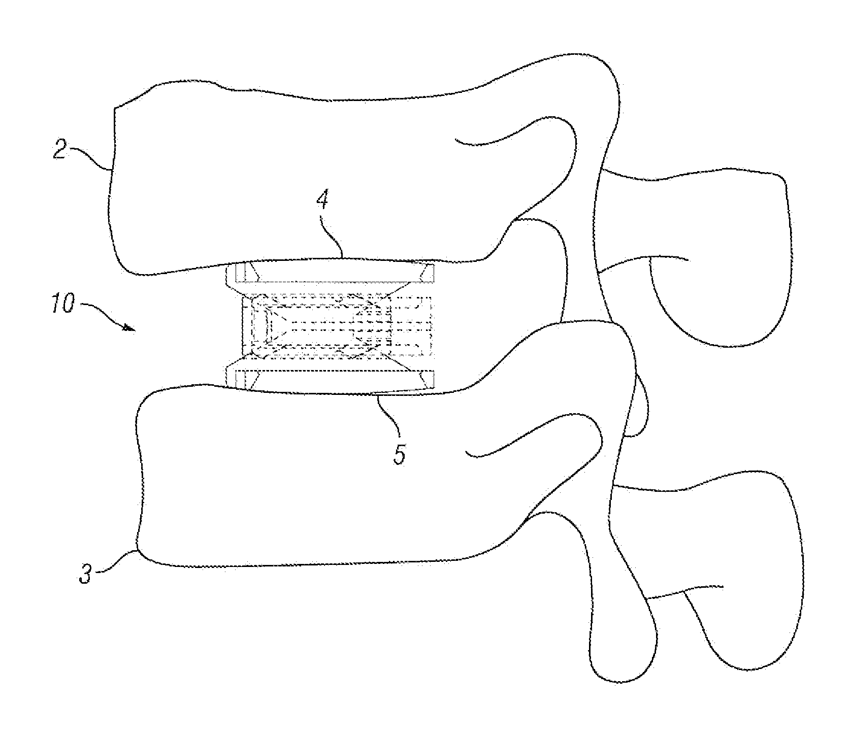 Expandable Fusion Device and Method of Installation Thereof