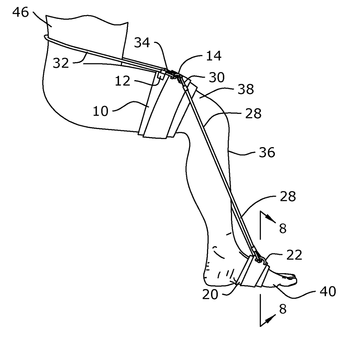 Plantar fasciitis treatment method and device