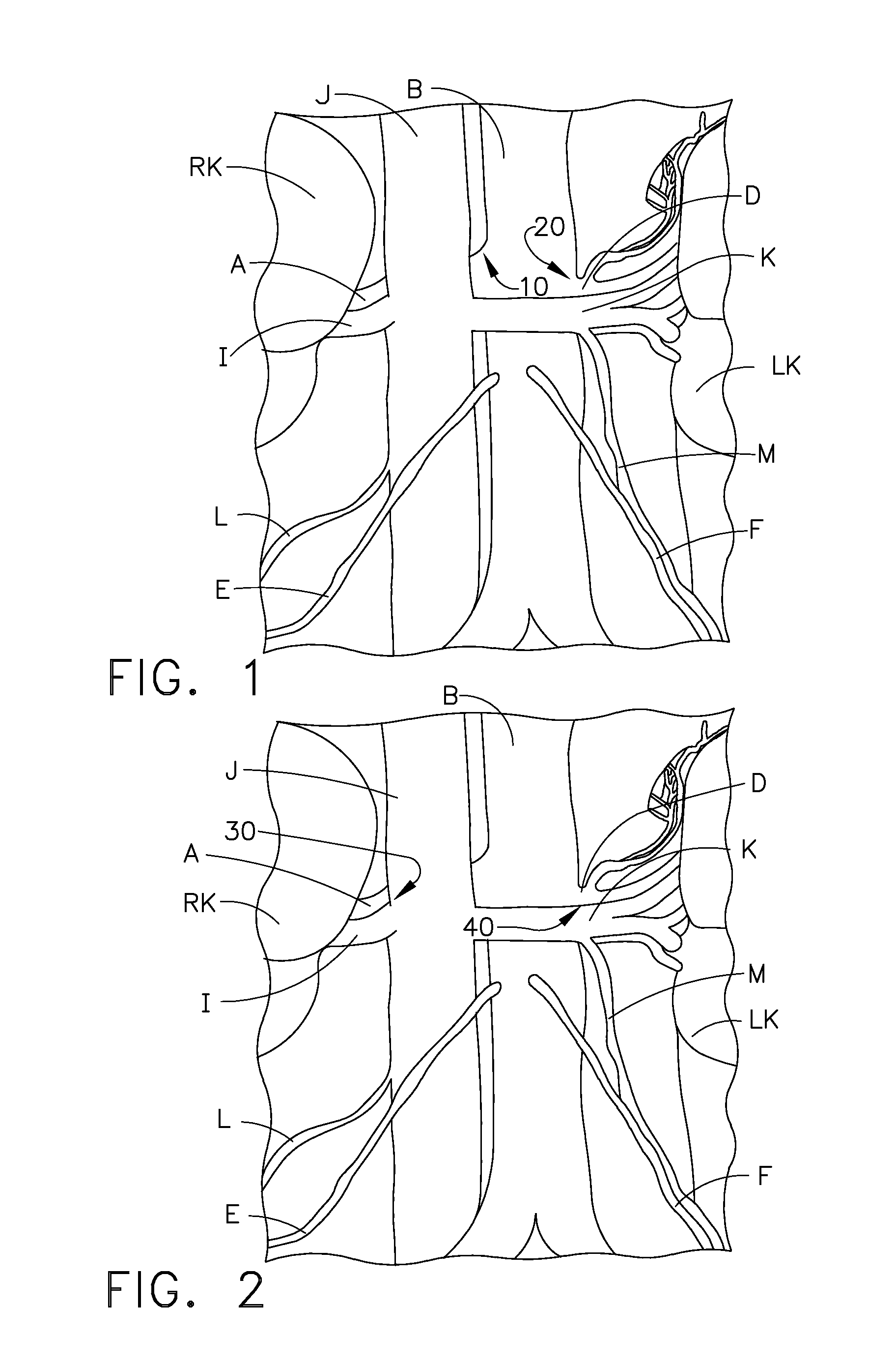 Ablation targeting nerves in or near the inferior vena cava and/or abdominal aorta for treatment of hypertension