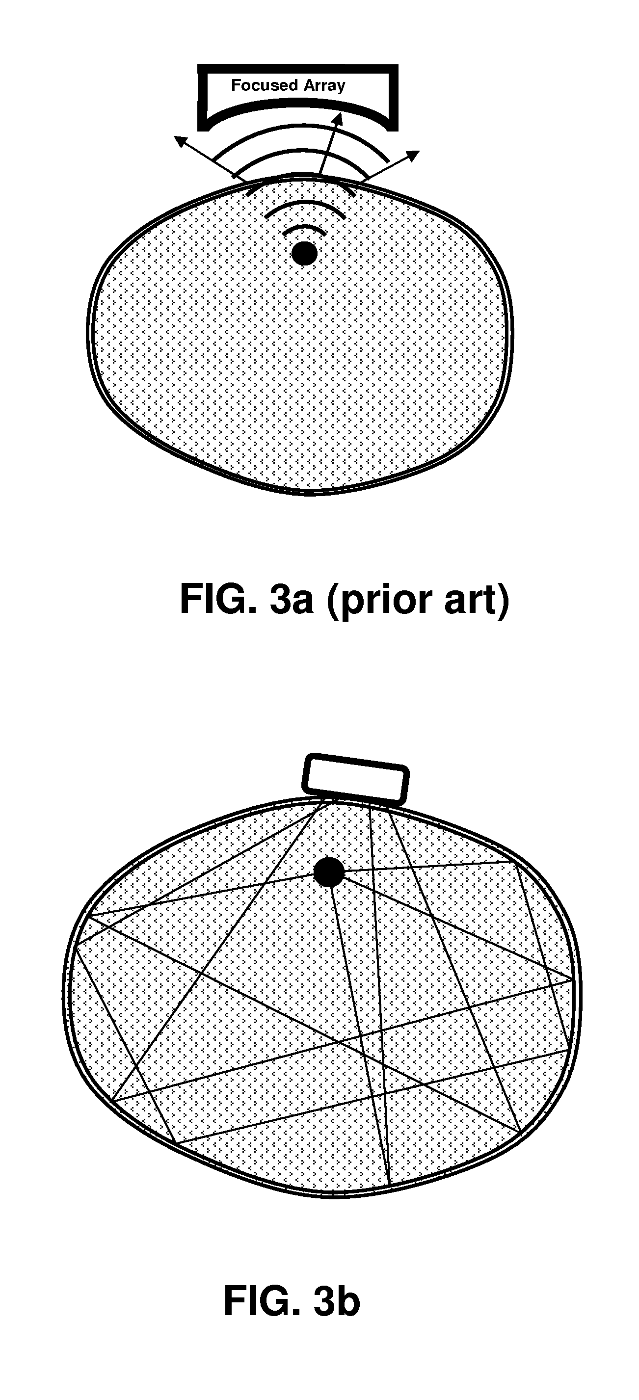 Leadless system for deep brain stimulation using time reversal acoustics