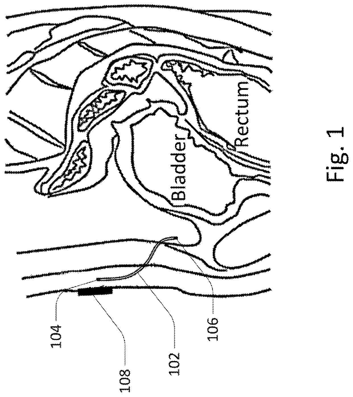 Methods and devices for analyte sensing in potential spaces