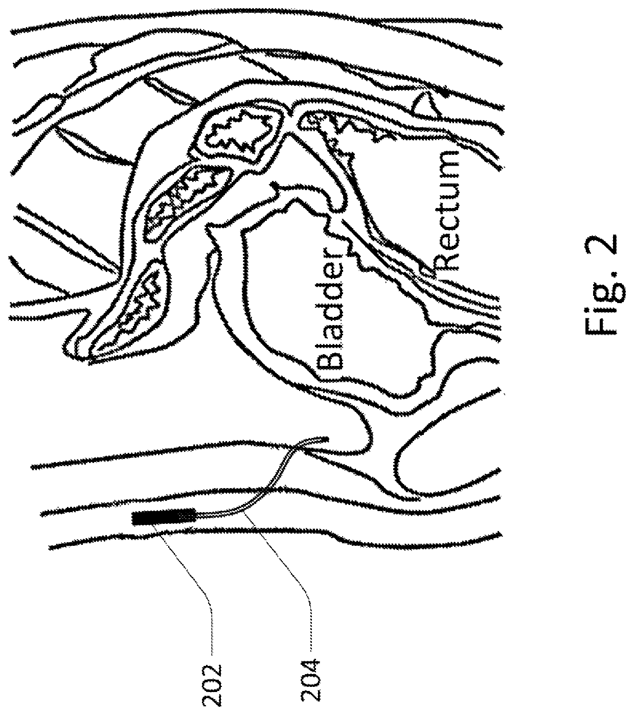 Methods and devices for analyte sensing in potential spaces