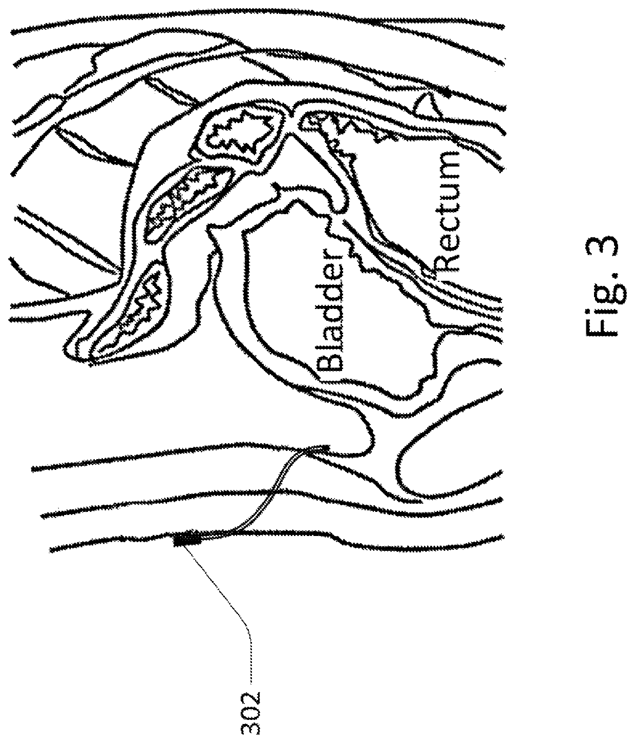 Methods and devices for analyte sensing in potential spaces