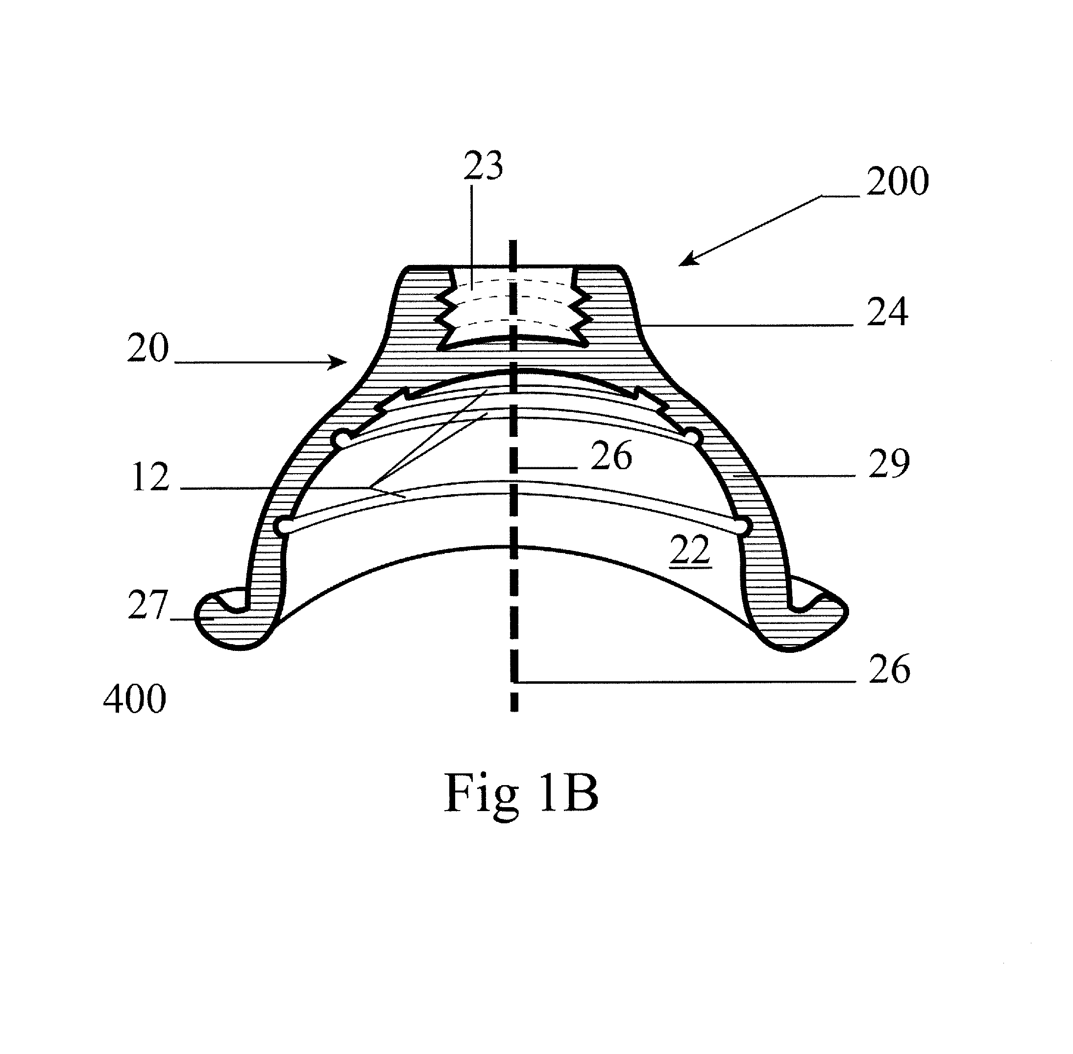 Shock absorbing implantable limb prosthetic