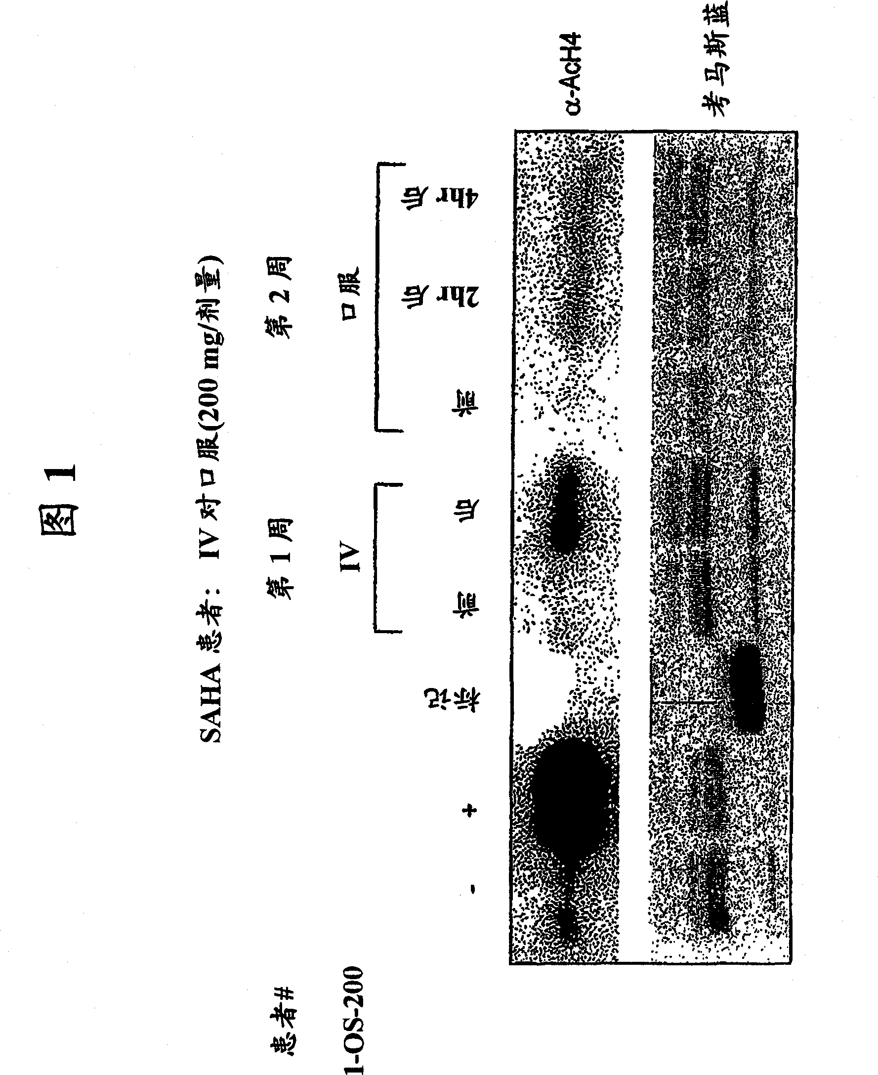 Methods of treating cancer with hdac inhibitors