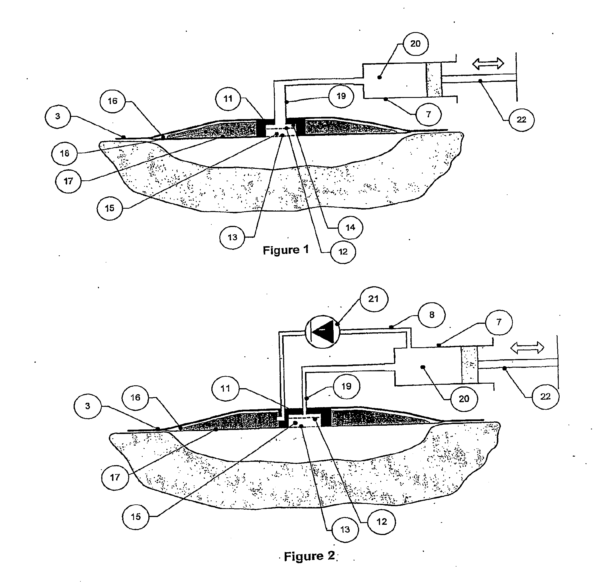 Wound cleansing apparatus in-situ