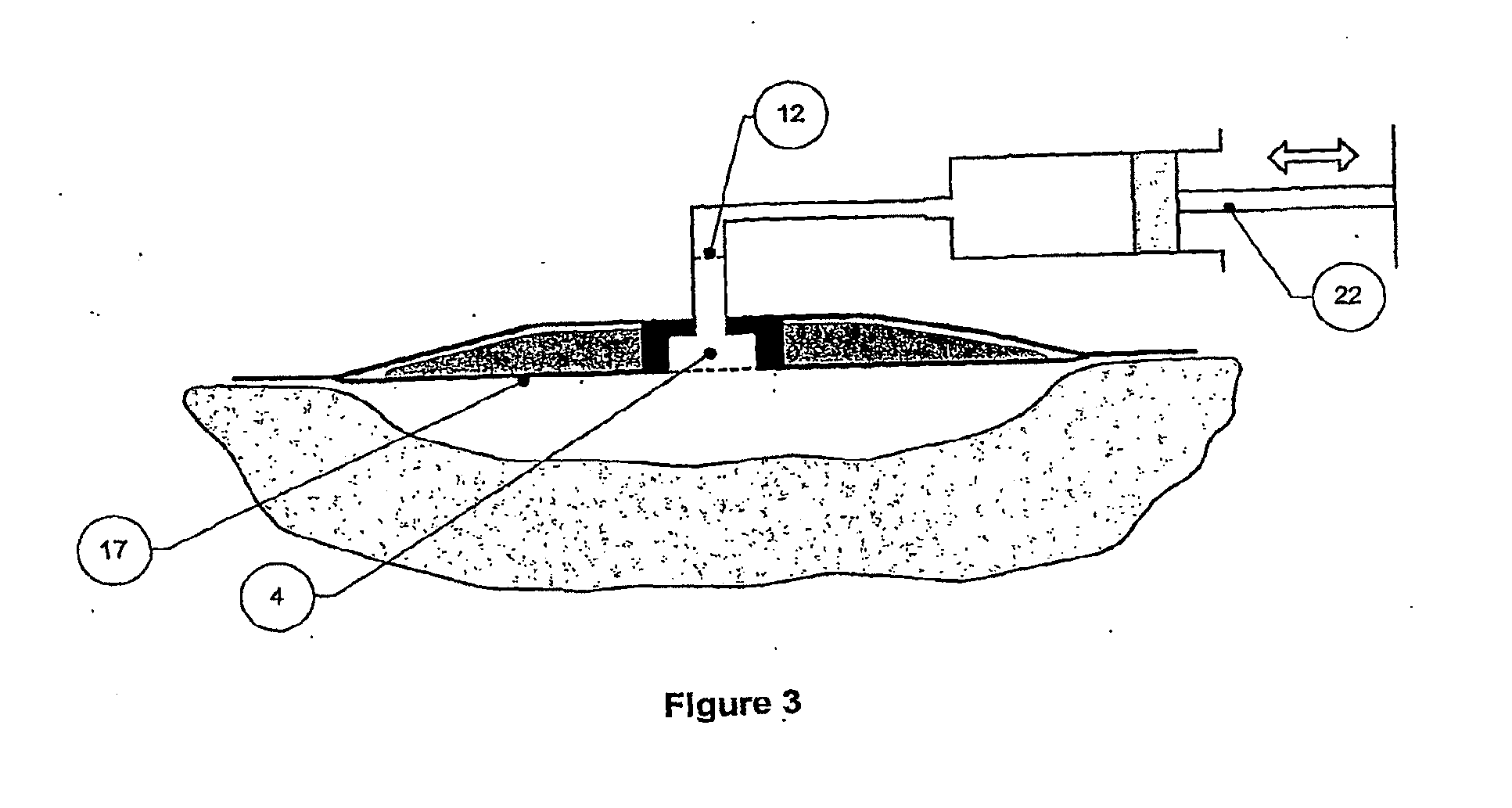 Wound cleansing apparatus in-situ