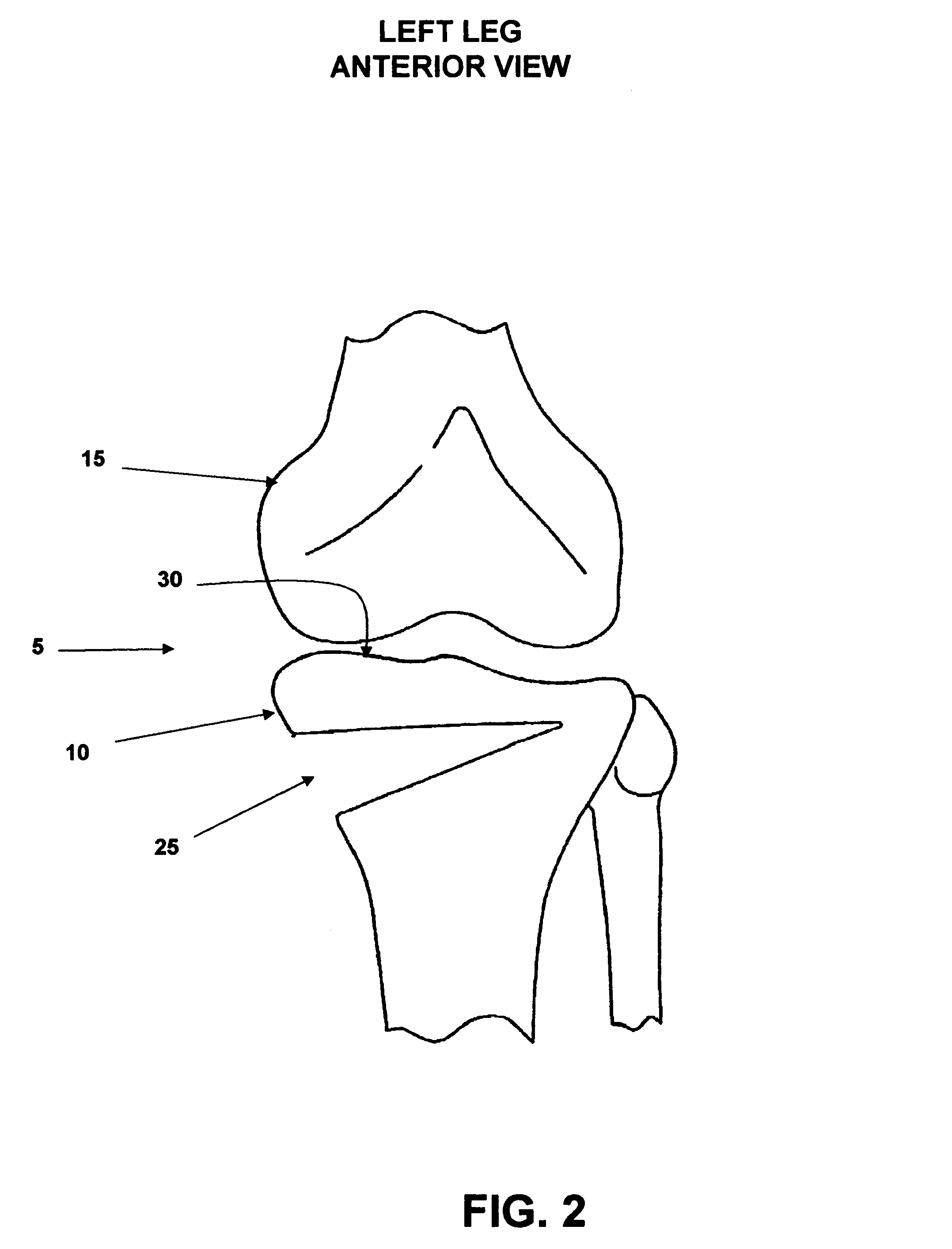 Method and apparatus for performing an open wedge, high tibial osteotomy