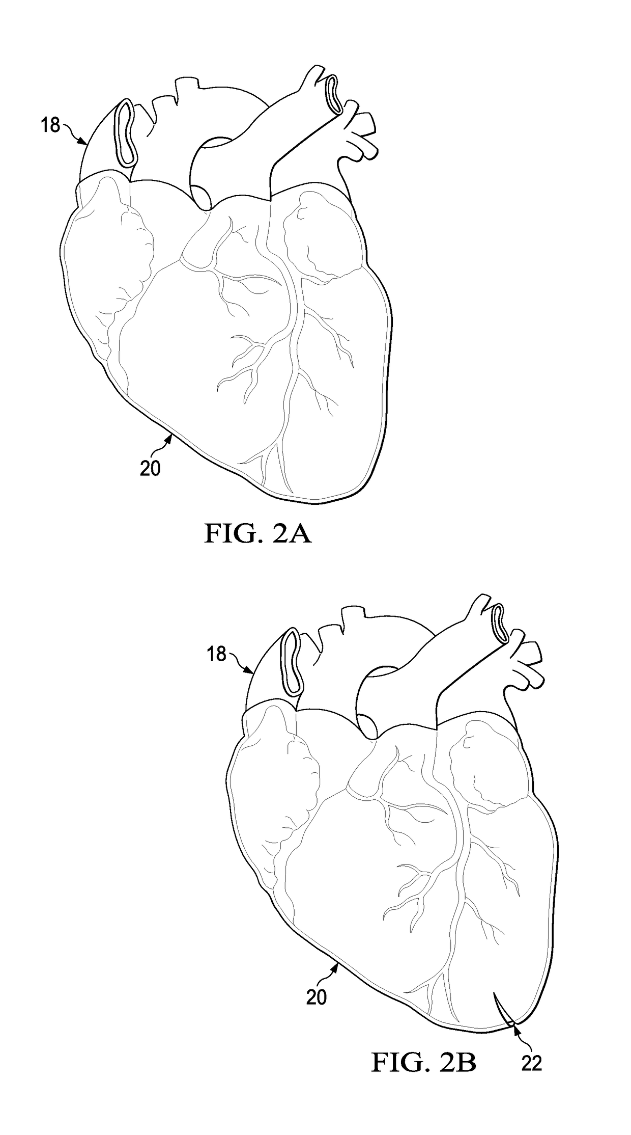 Apparatus and Method for Minimally Invasive Implantation of a Heart Assist Device