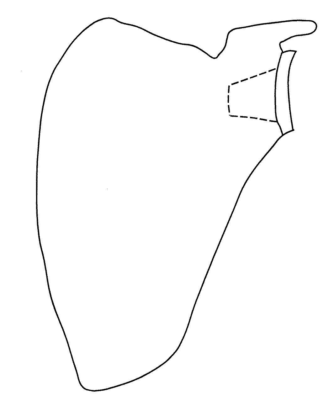 Methods of implanting glenoid inlay