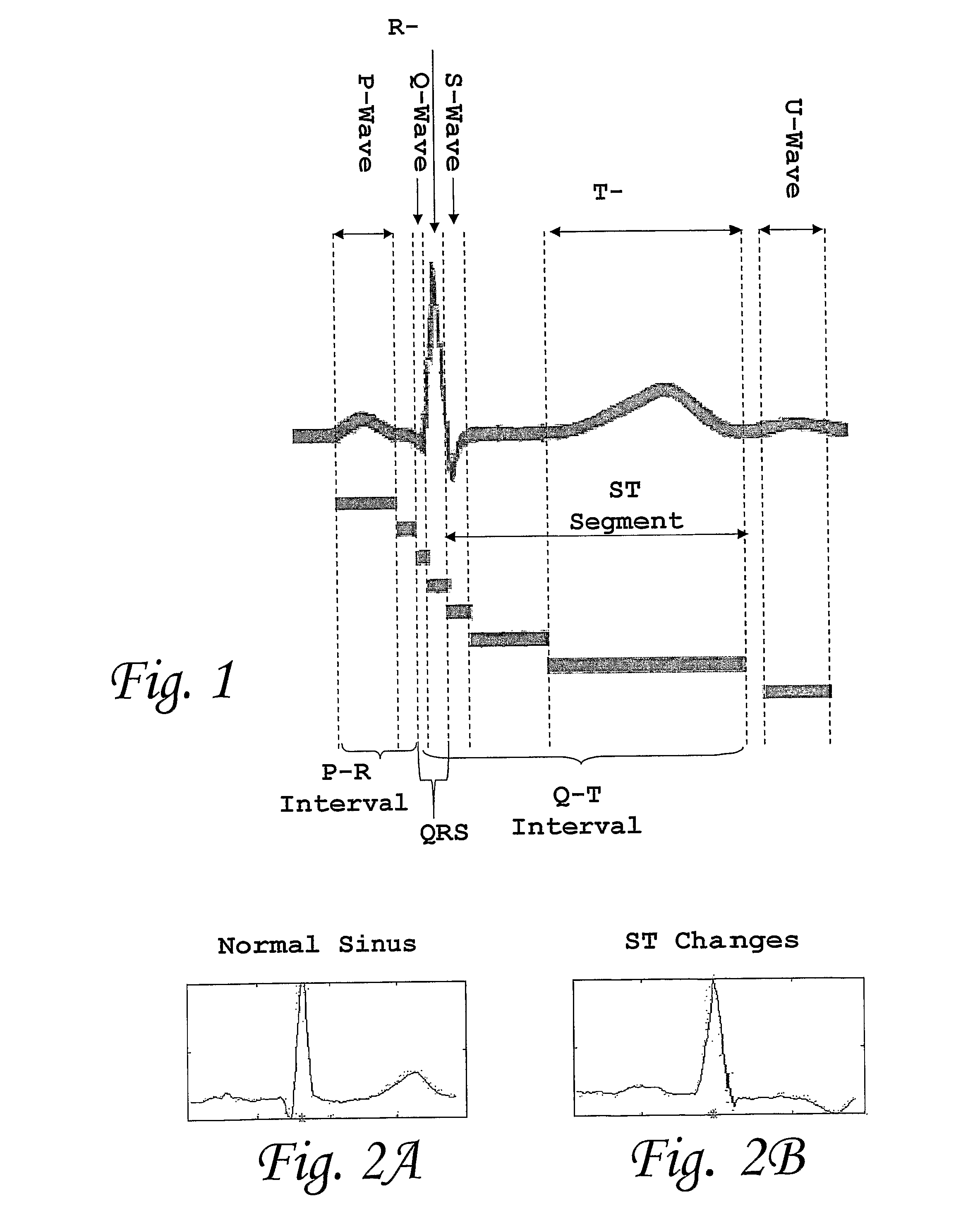 Method and System for Diagnosis of Cardiac Diseases Utilizing Neural Networks