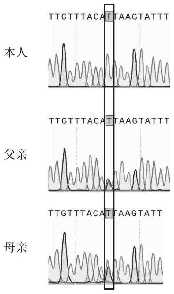 Application of HFM1 gene in preparation of diagnostic kit for detecting non-obstructive azoospermia