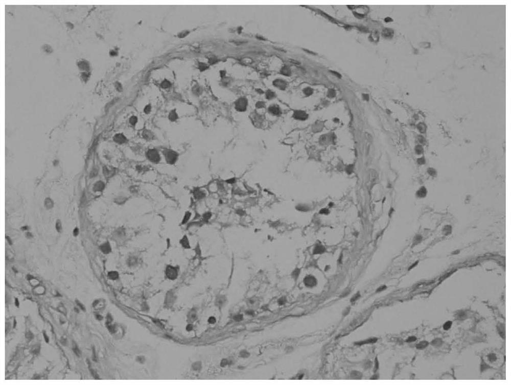 Application of HFM1 gene in preparation of diagnostic kit for detecting non-obstructive azoospermia