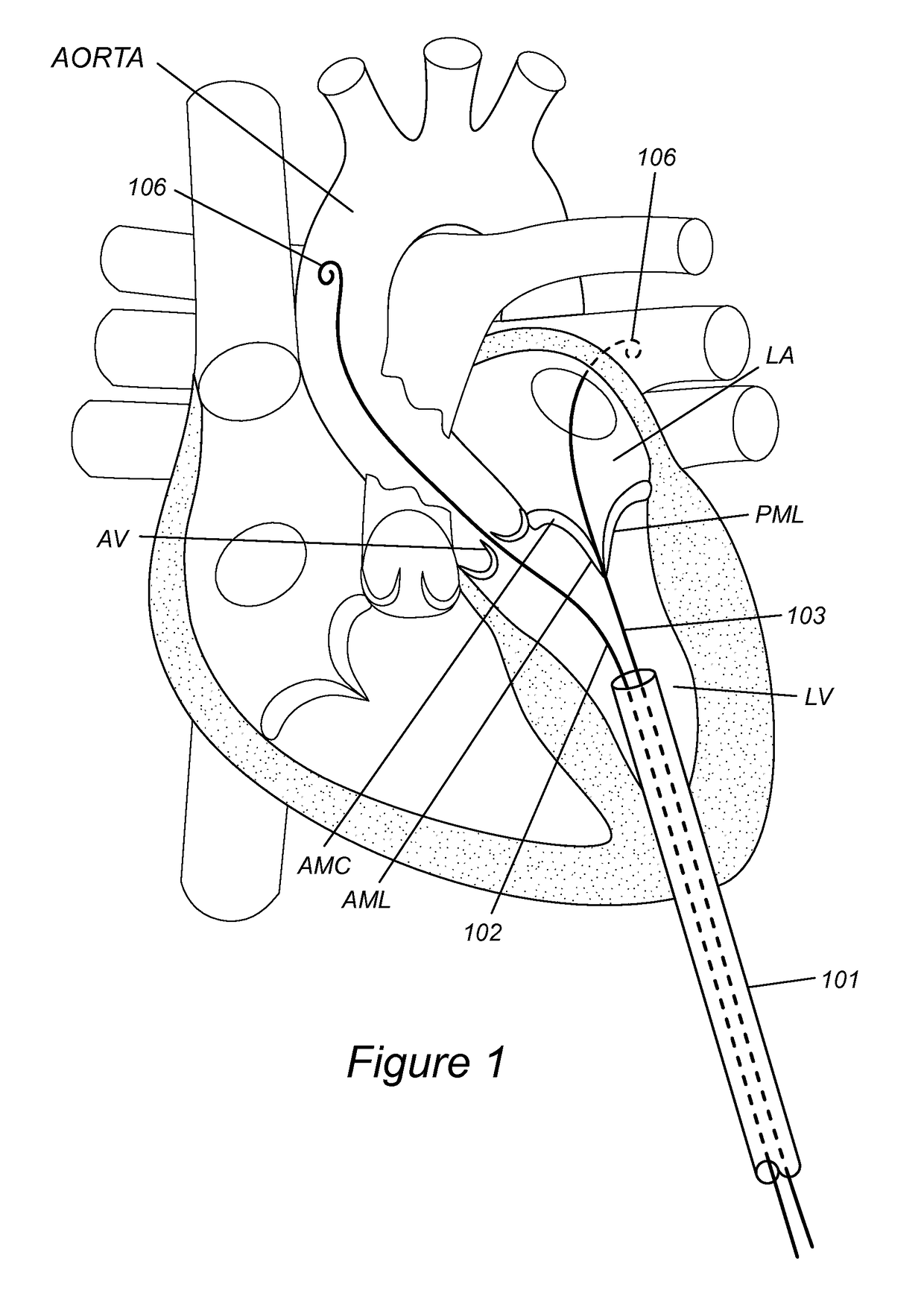 Anatomically-orientated and self-positioning transcatheter mitral valve