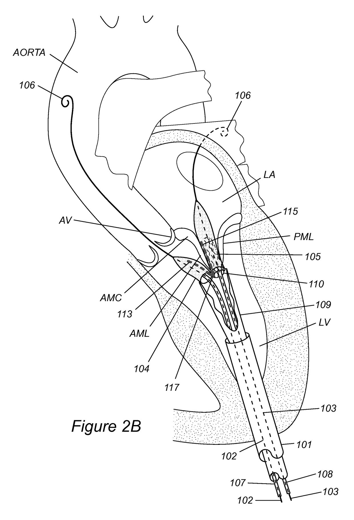 Anatomically-orientated and self-positioning transcatheter mitral valve