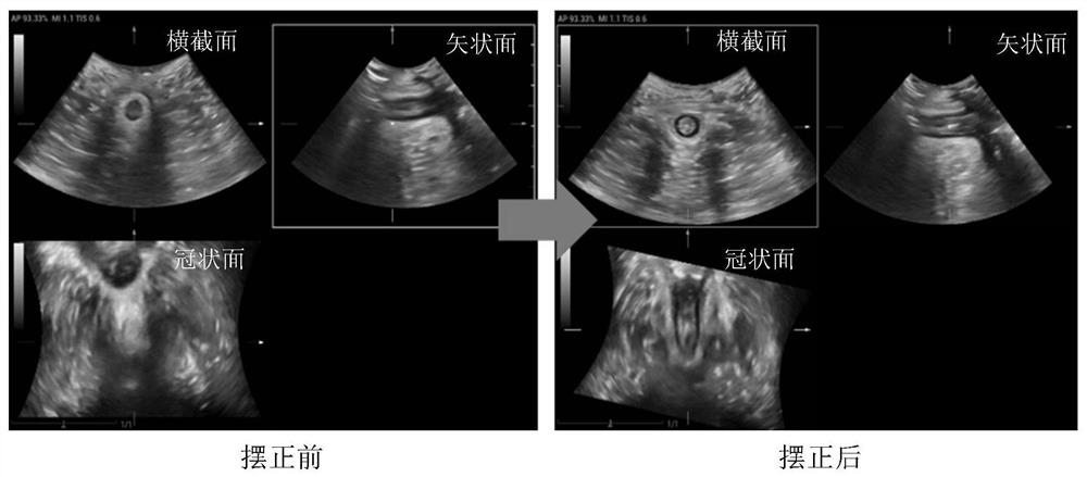 Ultrasonic imaging method and ultrasonic imaging system for anal sphincter