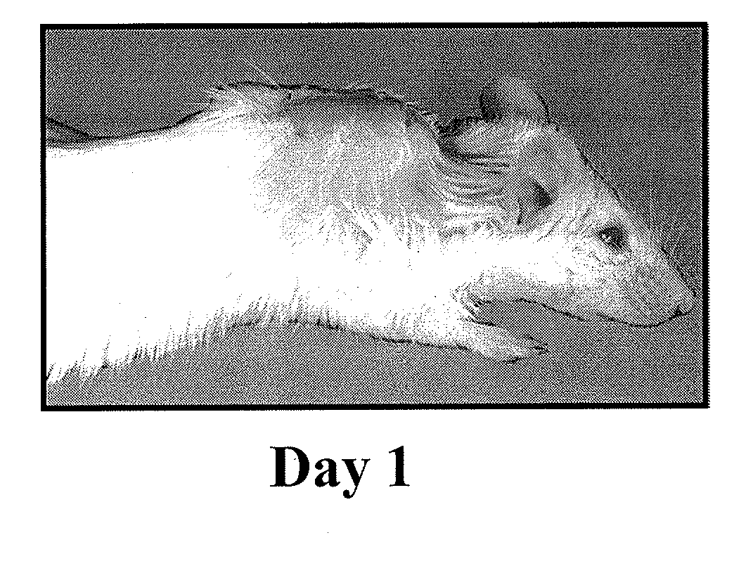 Methods for amyloid removal using Anti-amyloid antibodies