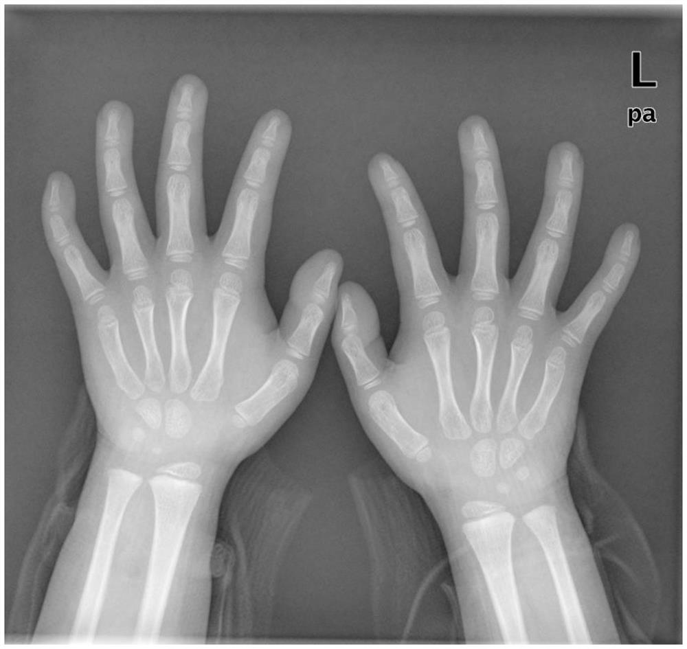 Bone age evaluation method and device based on deep convolutional neural network, and computer readable storage medium