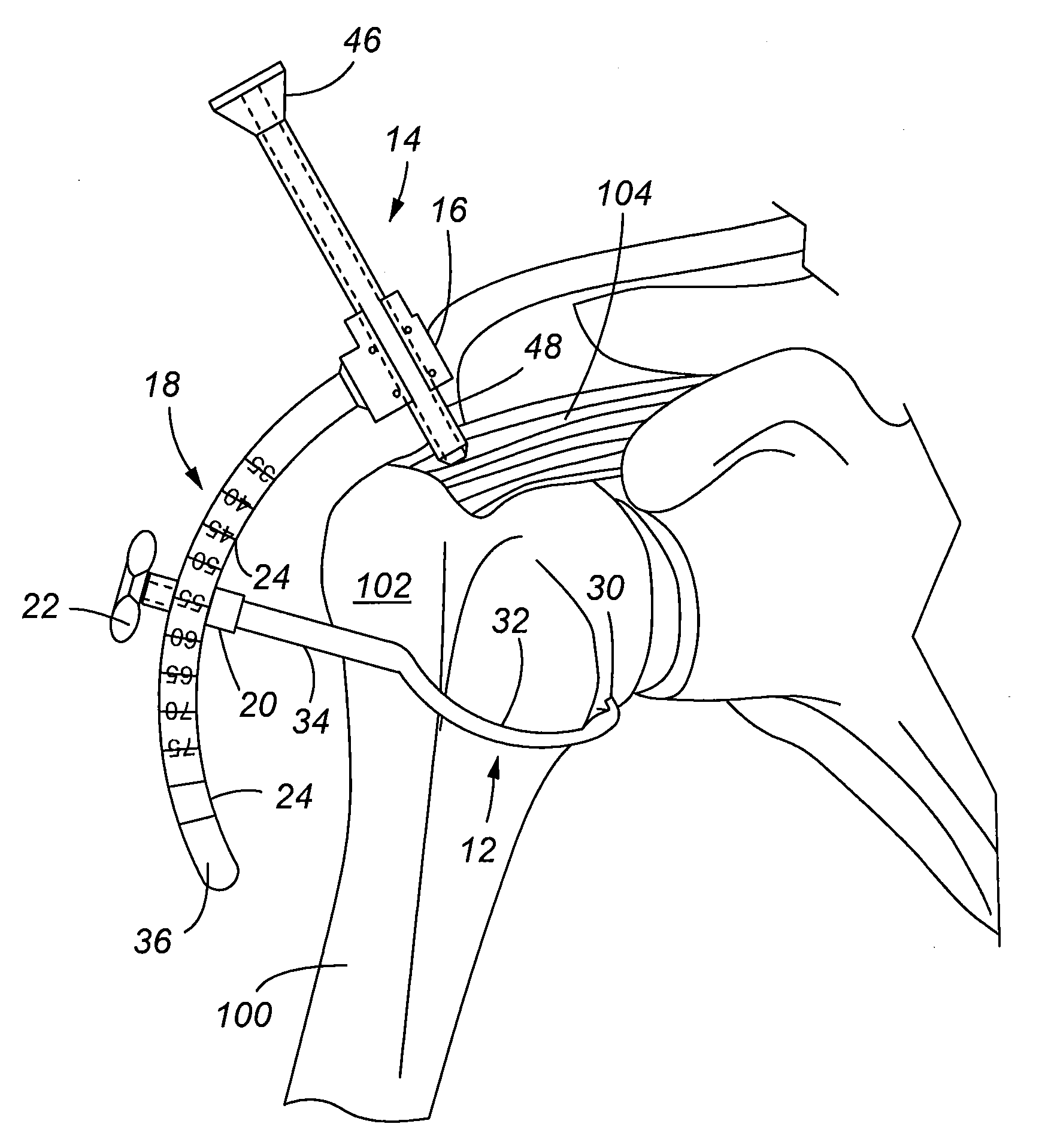 Apparatus and method for arthroscopic transhumeral rotator cuff repair