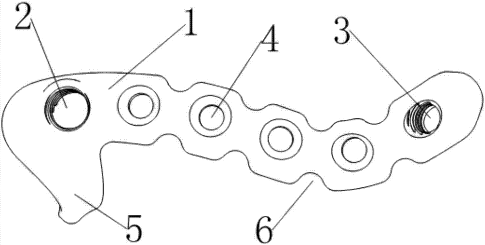 A posterior fixation plate for acetabular anterior and posterior column fractures