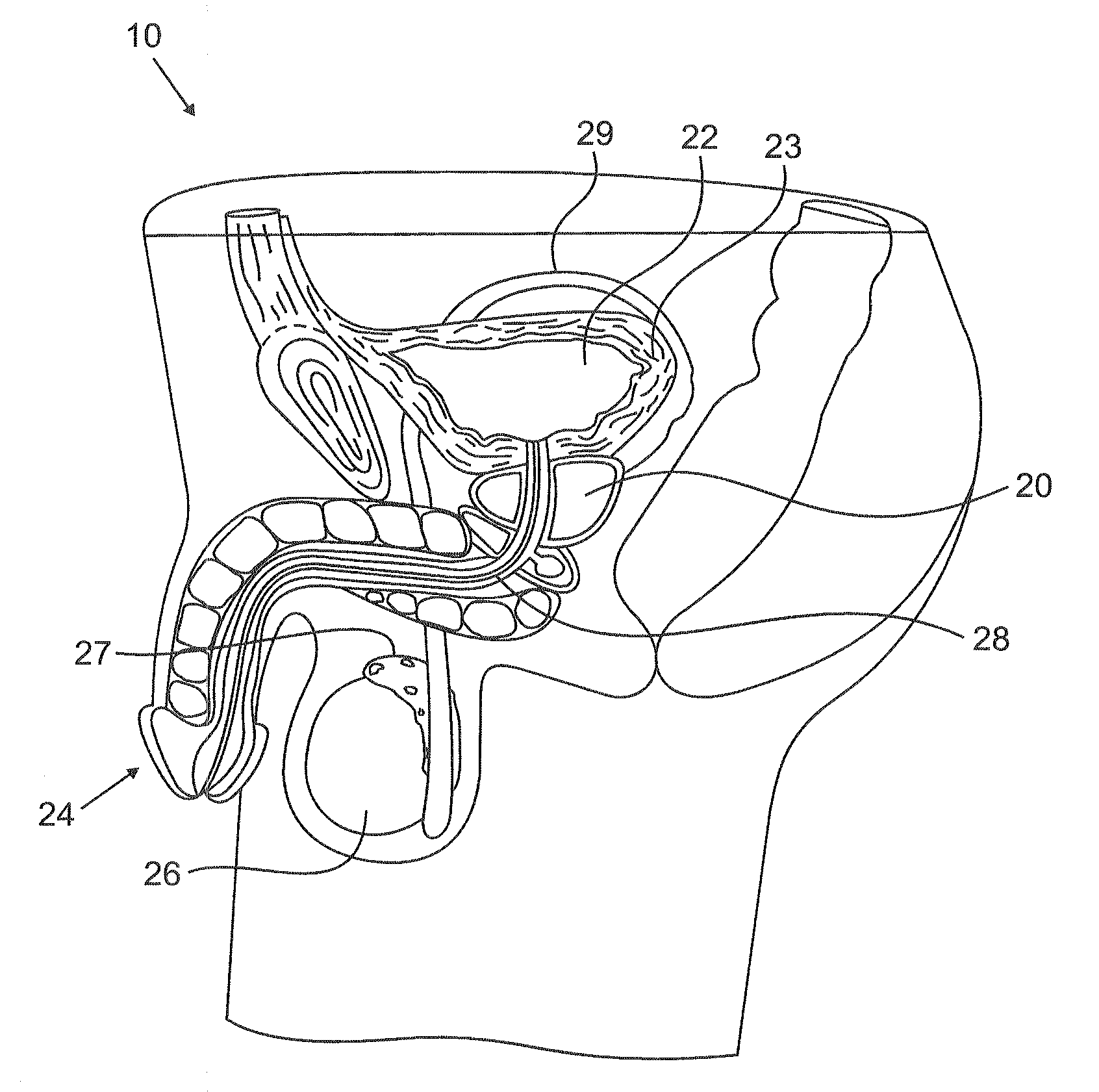 Urological medical devices for release of prostatically beneficial therapeutic agents