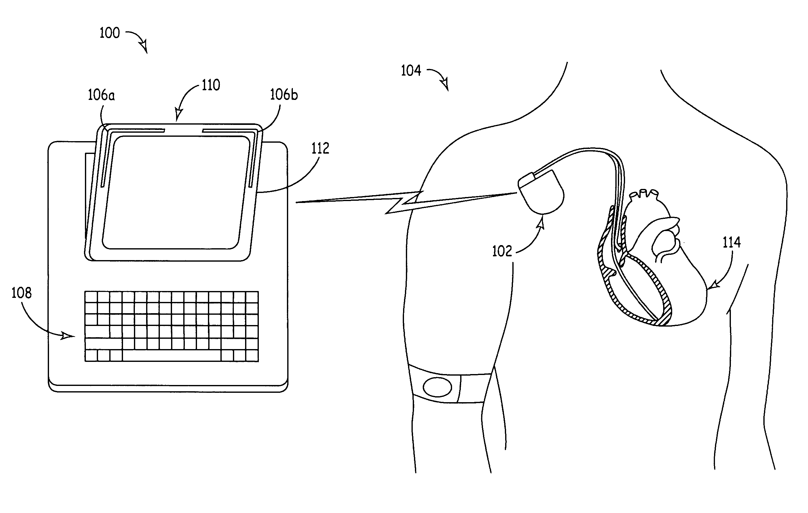 Compact conformal antenna for an implanted medical device telemetry system