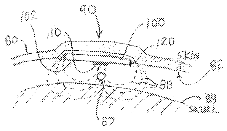 Implantable Electroacupuncture System and Method for Treating Depression and Similar Mental Conditions