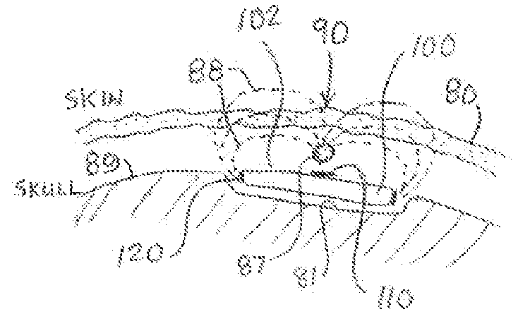 Implantable Electroacupuncture System and Method for Treating Depression and Similar Mental Conditions