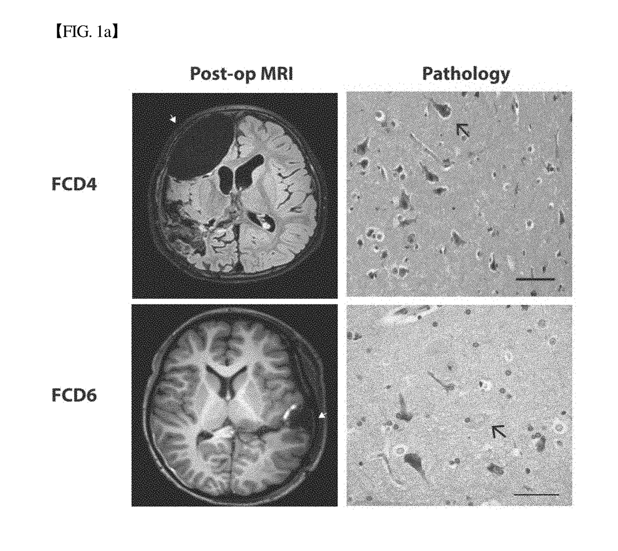 COMPOSITION FOR PREVENTION OR TREATMENT OF INTRACTABLE EPILEPSY COMPRISING mTOR INHIBITOR