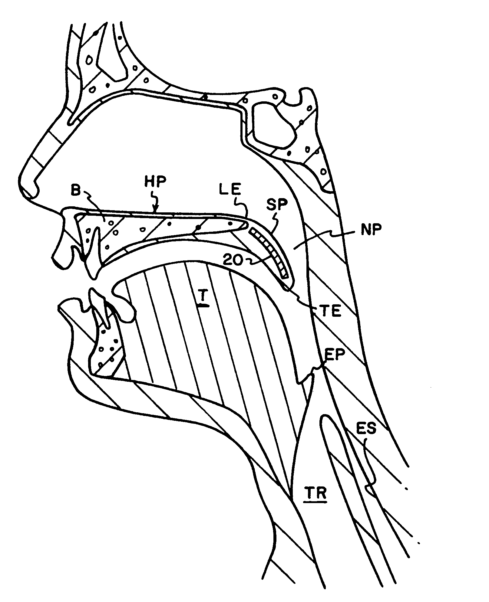 Airway stiffening implant