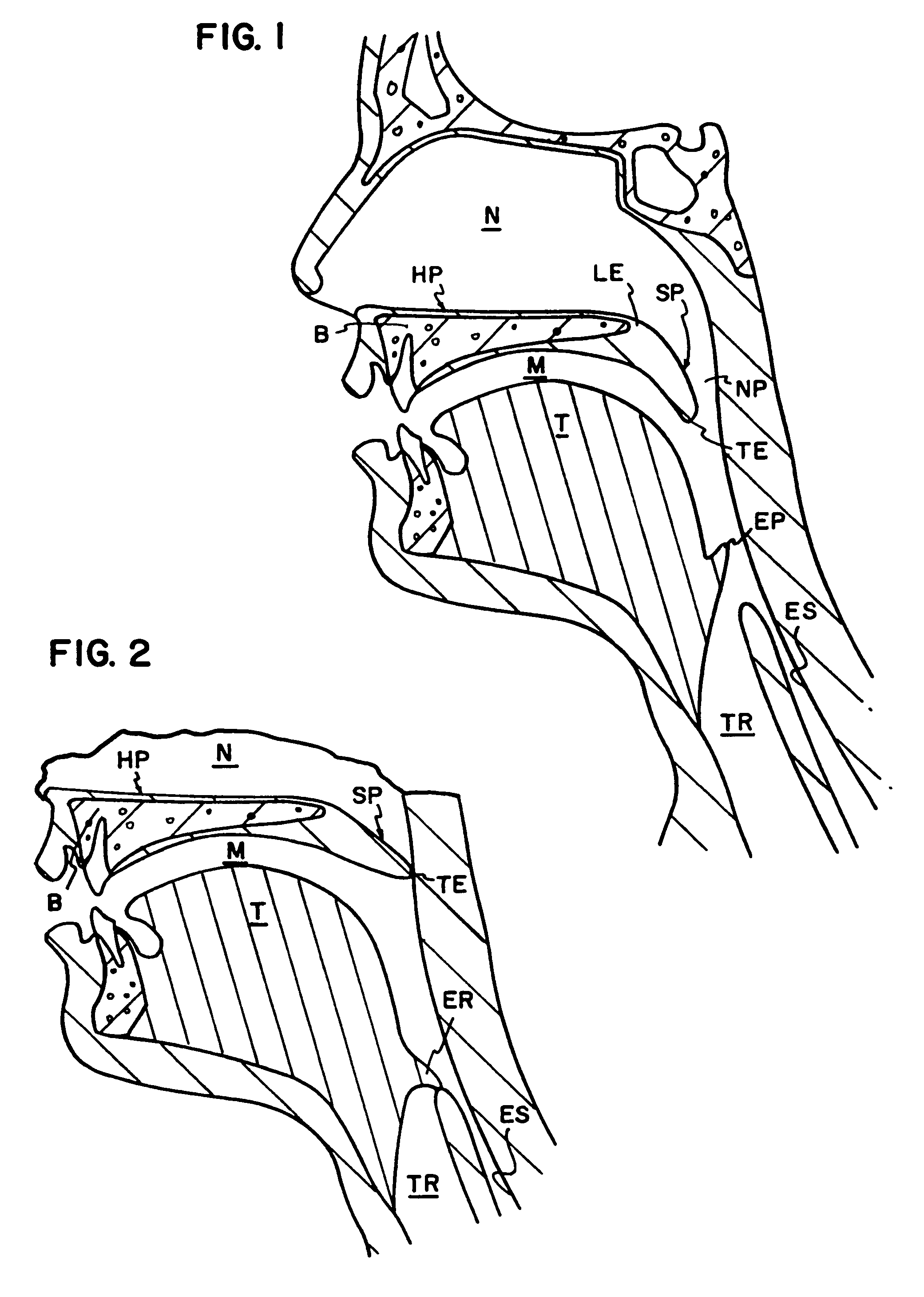 Airway stiffening implant