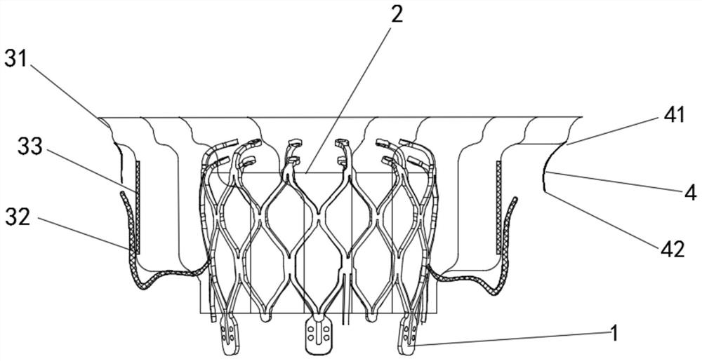 Valve prosthesis capable of effectively improving perivalvular leakage