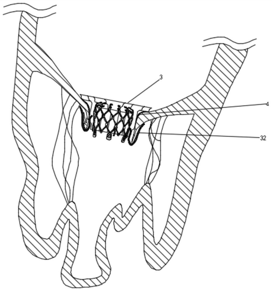 Valve prosthesis capable of effectively improving perivalvular leakage