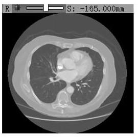 CT image lung lobe method and system