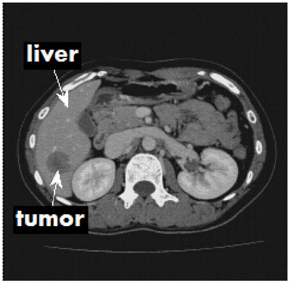 A Fully Automatic 3D Liver Segmentation Method Based on Convolutional Neural Networks