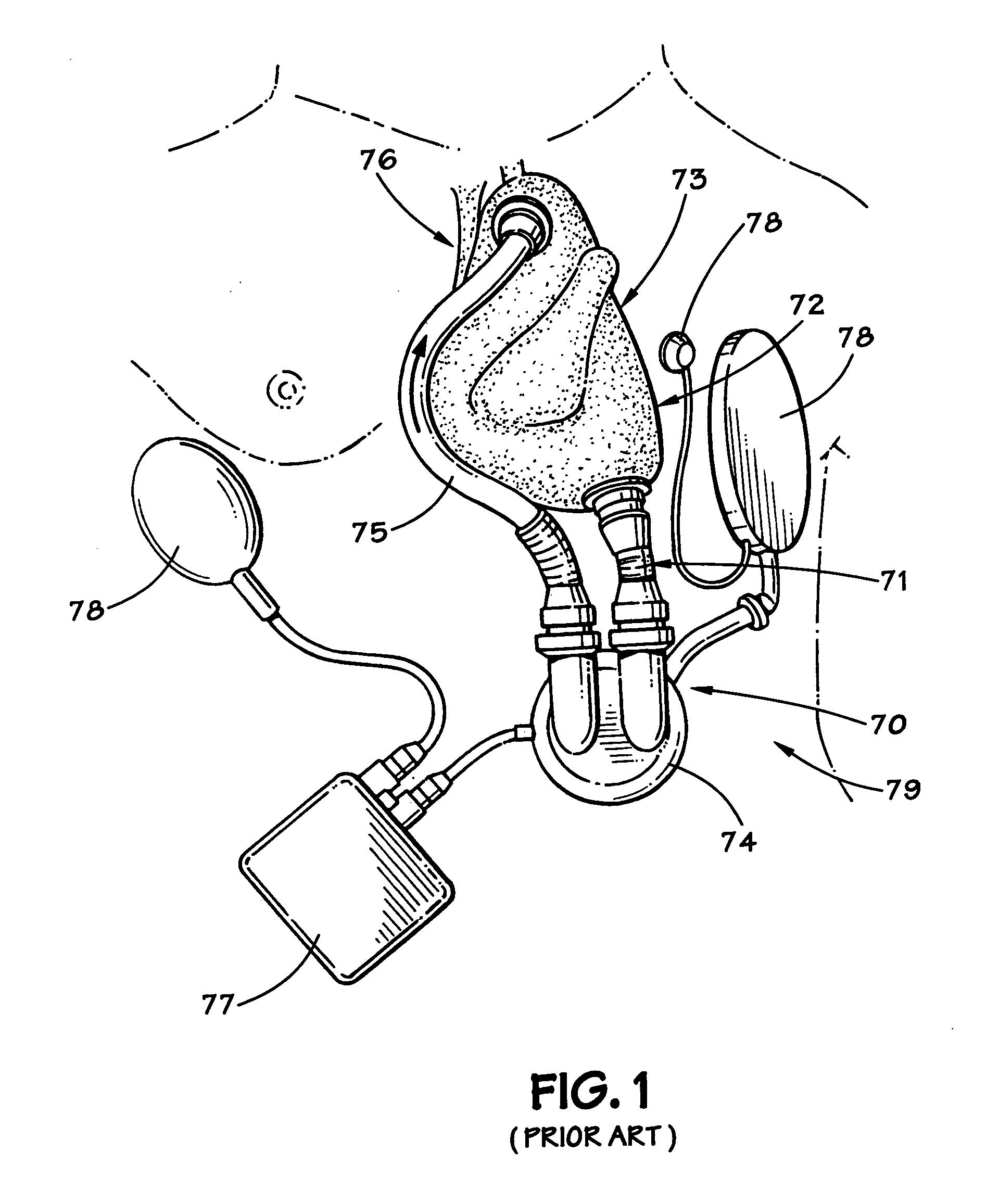 Method and apparatus for long-term assisting a left ventricle to pump blood