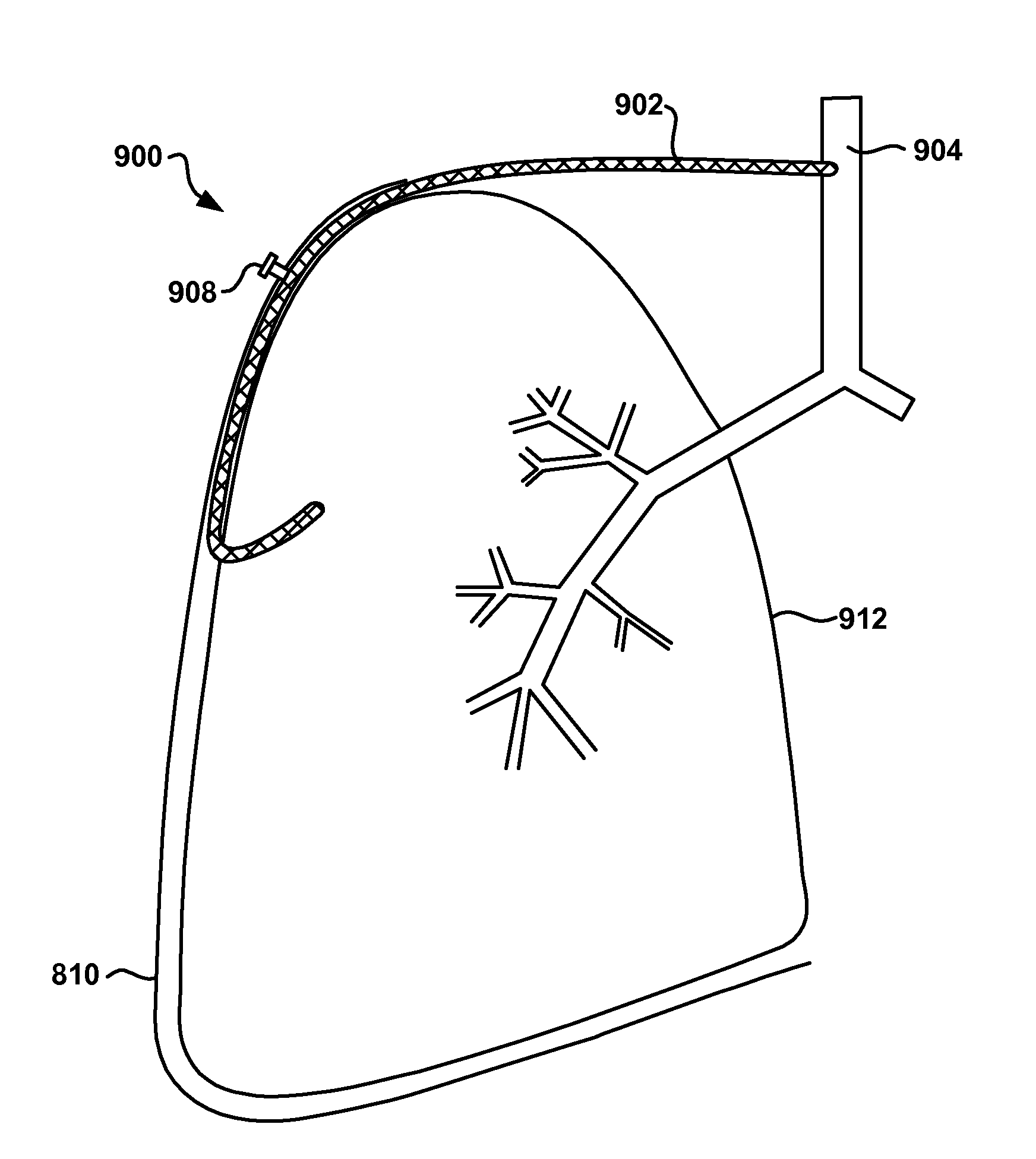 Intra-thoracic collateral ventilation bypass system