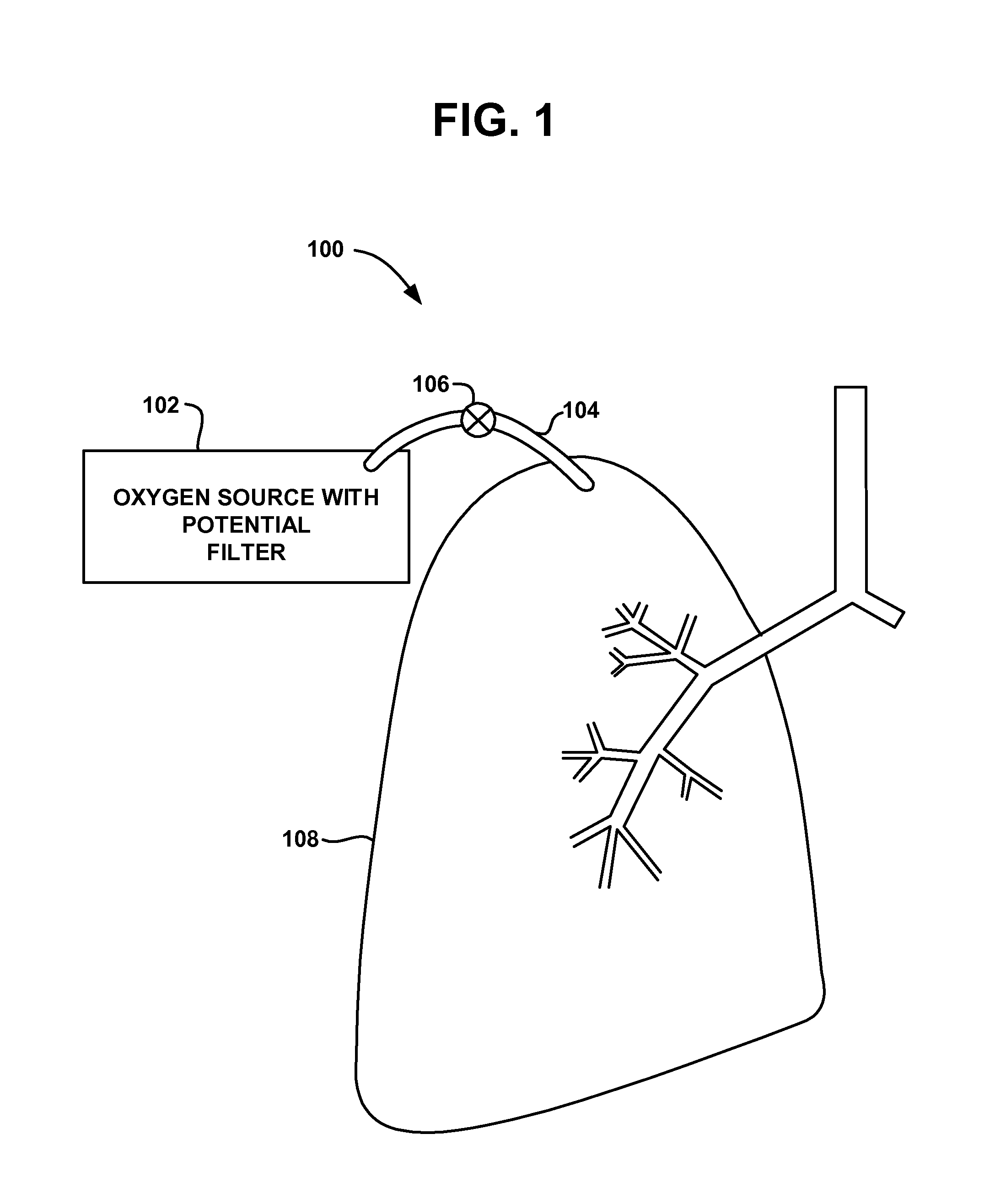 Intra-thoracic collateral ventilation bypass system