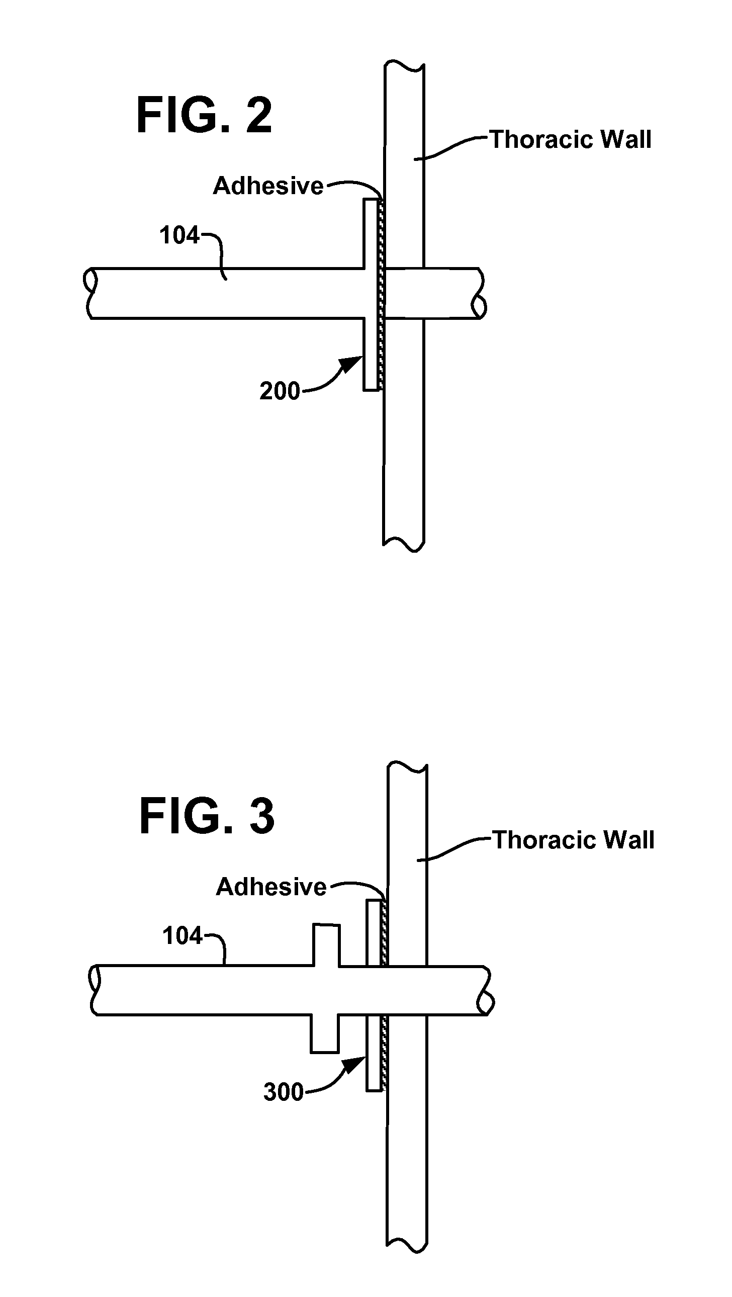 Intra-thoracic collateral ventilation bypass system